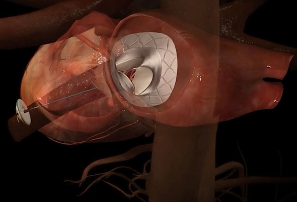 World's First Transcatheter Mitral Valve