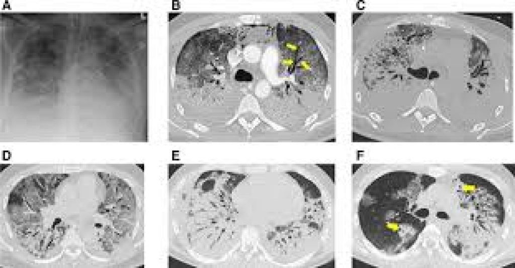 Covid 19 symptoms and CT scan